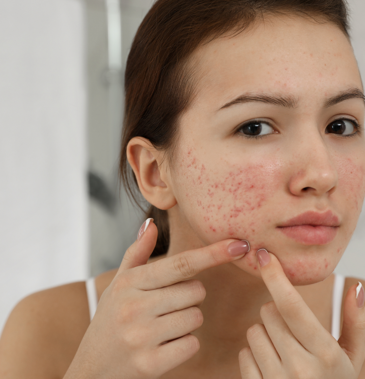 Acne - SieroSanto Ieper