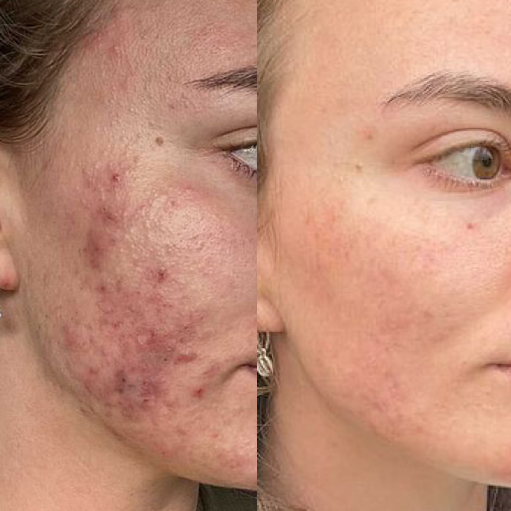 Platinum HydraFacial + Glow Peel-Behandlung – SieroSanto Skin Clinic