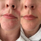 Platinum HydraFacial + Glow Peel-Behandlung – SieroSanto Skin Clinic