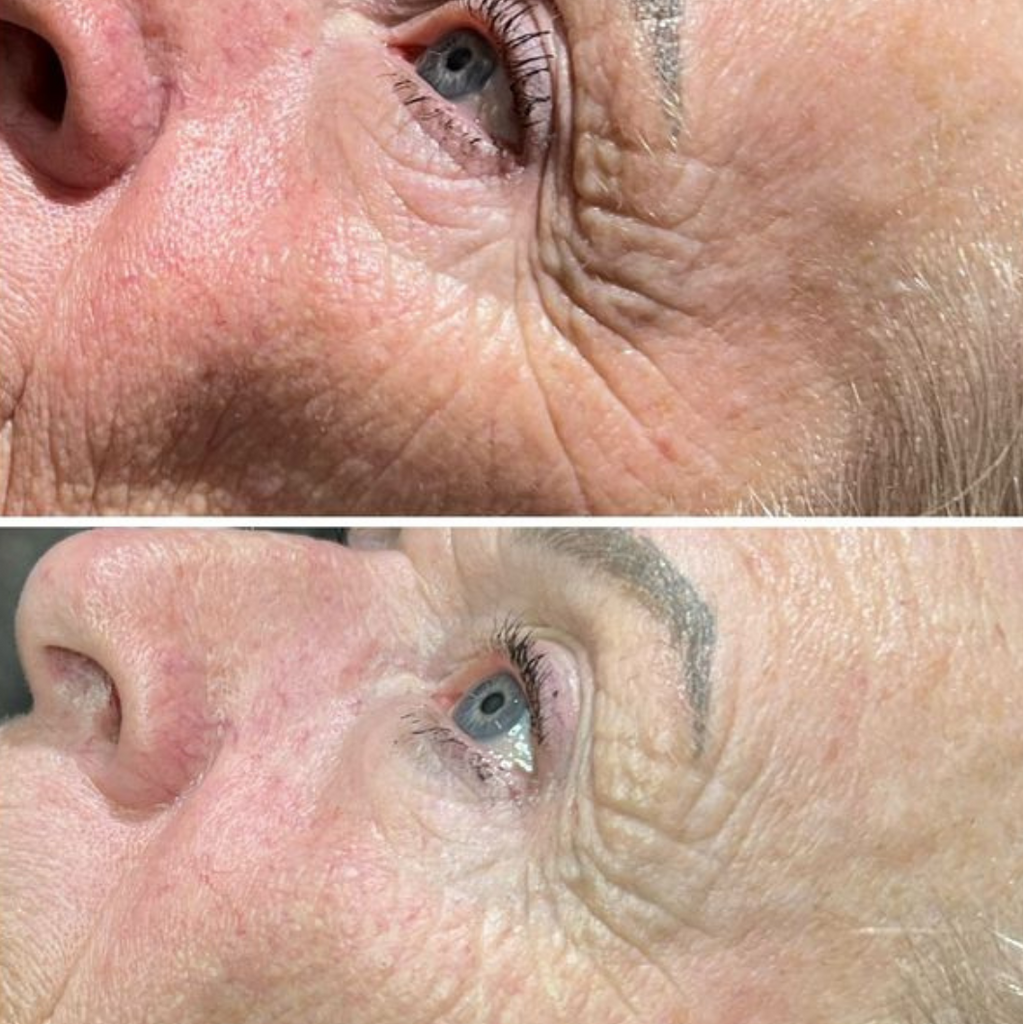 Platinum HydraFacial + Glow Peel-Behandlung – SieroSanto Skin Clinic