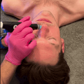 HydraFacial Platinum - SieroSanto Skin Clinic - SieroSanto