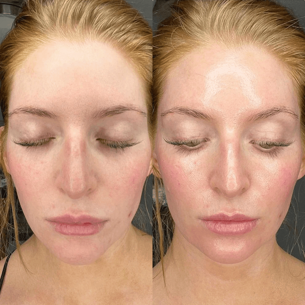 Glowpeel Ultimate Relax & Glow Behandeling - SieroSanto Skin Clinic - SieroSanto