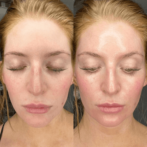 Glowpeel Ultimate Relax & Glow Behandeling - SieroSanto Skin Clinic - SieroSanto